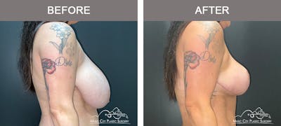 Breast Lift Before & After Gallery - Patient 196294443 - Image 3