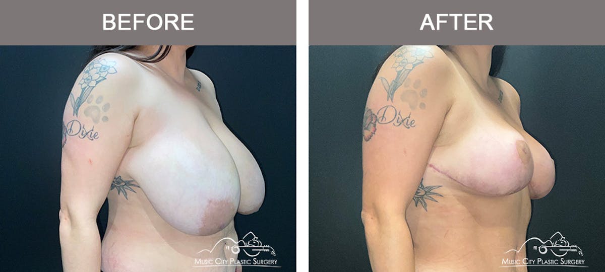 Breast Lift Before & After Gallery - Patient 196294443 - Image 2