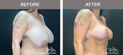 Breast Lift Before & After Gallery - Patient 196294443 - Image 2