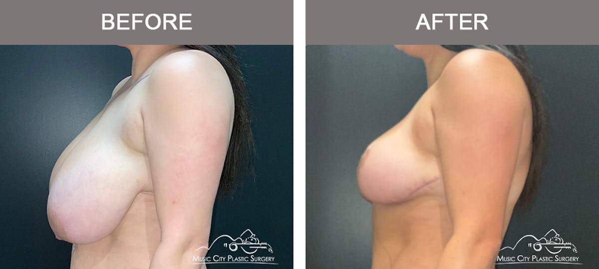 Breast Lift Before & After Gallery - Patient 196294443 - Image 5