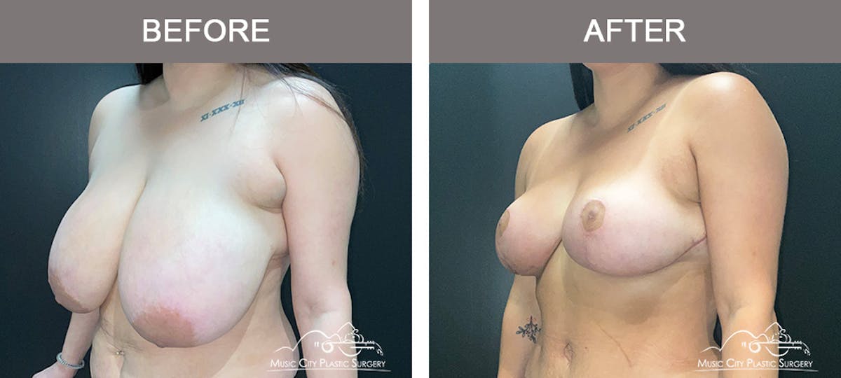 Breast Lift Before & After Gallery - Patient 196294443 - Image 4