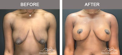 Breast Lift Before & After Gallery - Patient 196294445 - Image 1