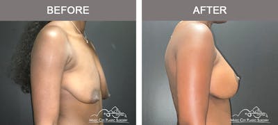 Breast Lift Before & After Gallery - Patient 196294445 - Image 3