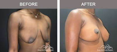 Breast Lift Before & After Gallery - Patient 196294445 - Image 2
