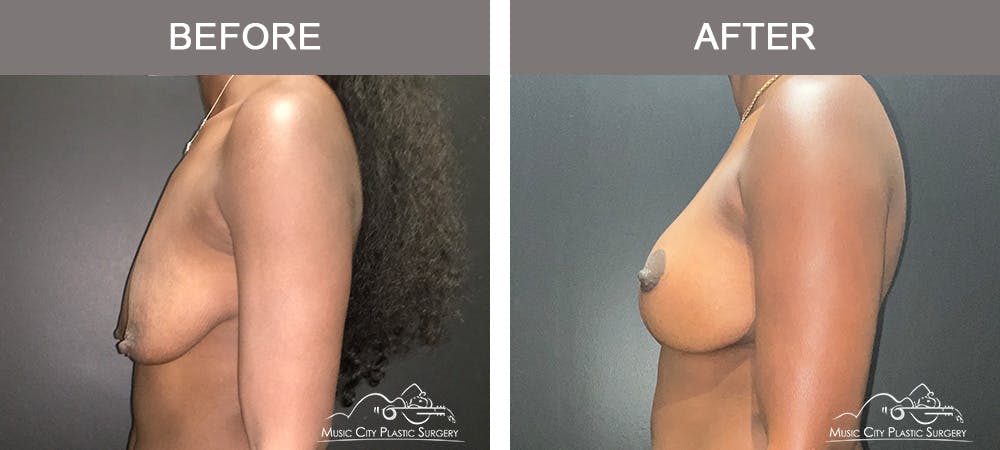Breast Lift Before & After Gallery - Patient 196294445 - Image 5