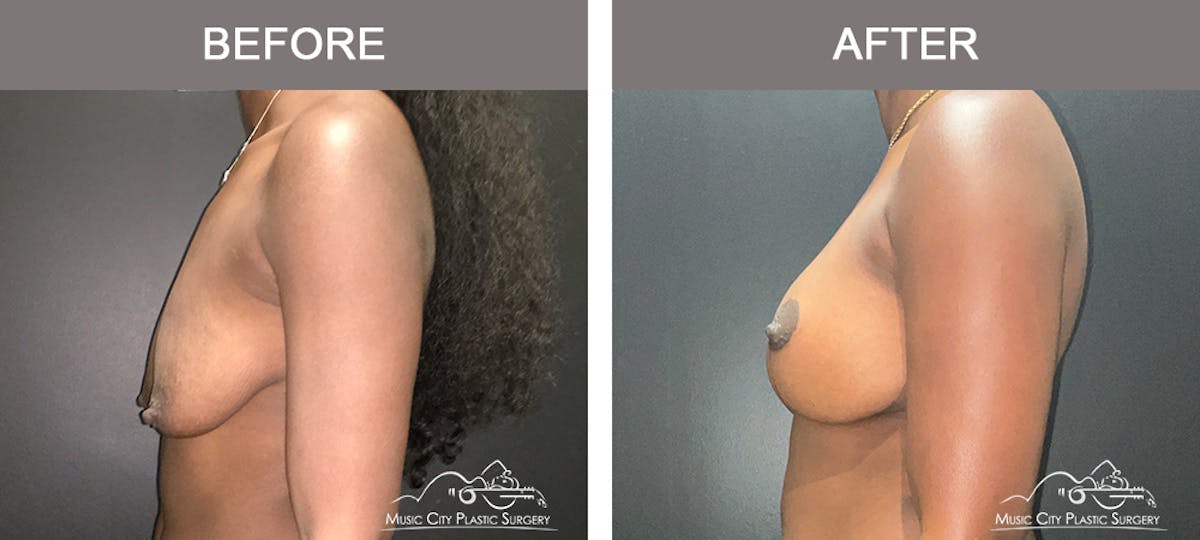 Breast Lift Before & After Gallery - Patient 196294445 - Image 5