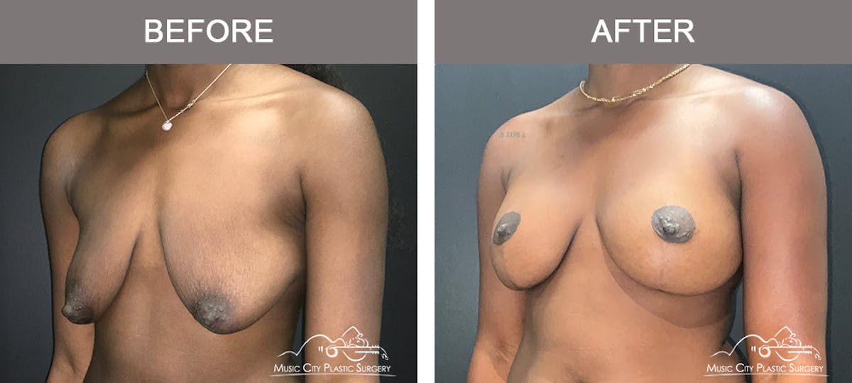 Breast Lift Before & After Gallery - Patient 196294445 - Image 4