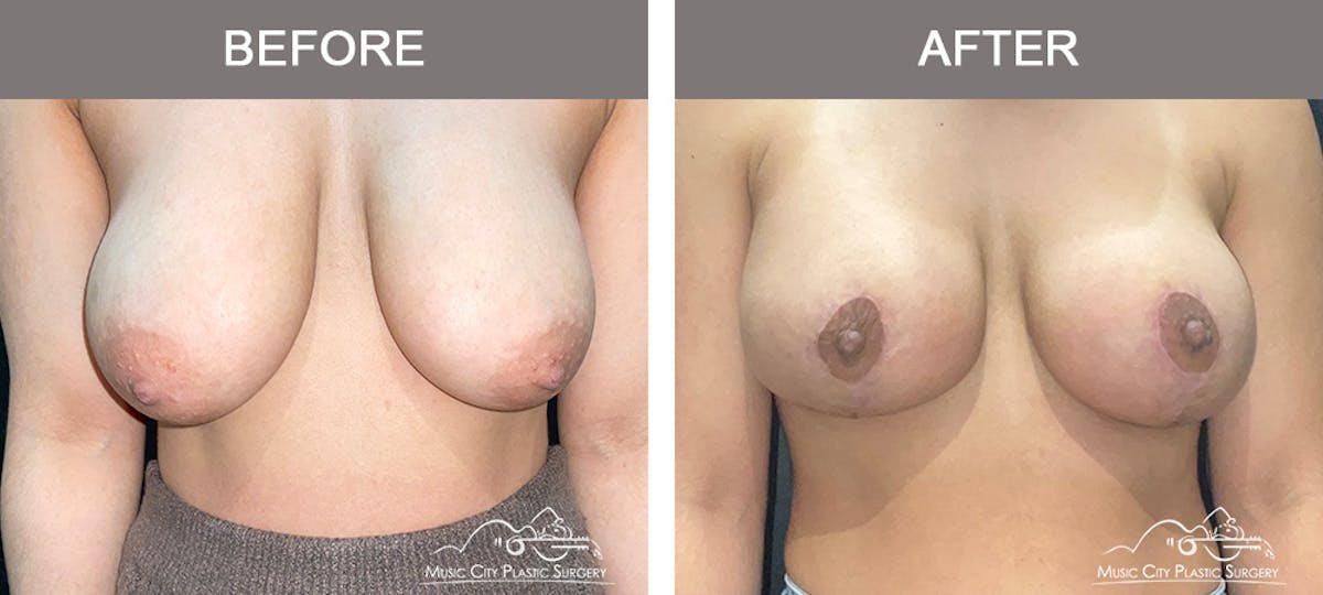 Breast Lift Before & After Gallery - Patient 196294447 - Image 1