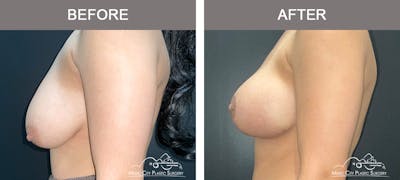 Breast Lift Before & After Gallery - Patient 196294447 - Image 3