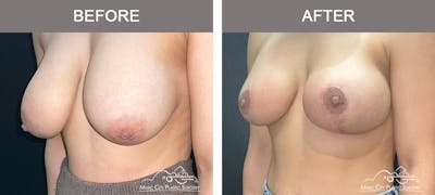 Breast Lift Before & After Gallery - Patient 196294447 - Image 2