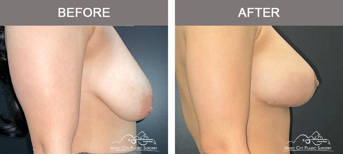 Breast Lift Before & After Gallery - Patient 196294447 - Image 5