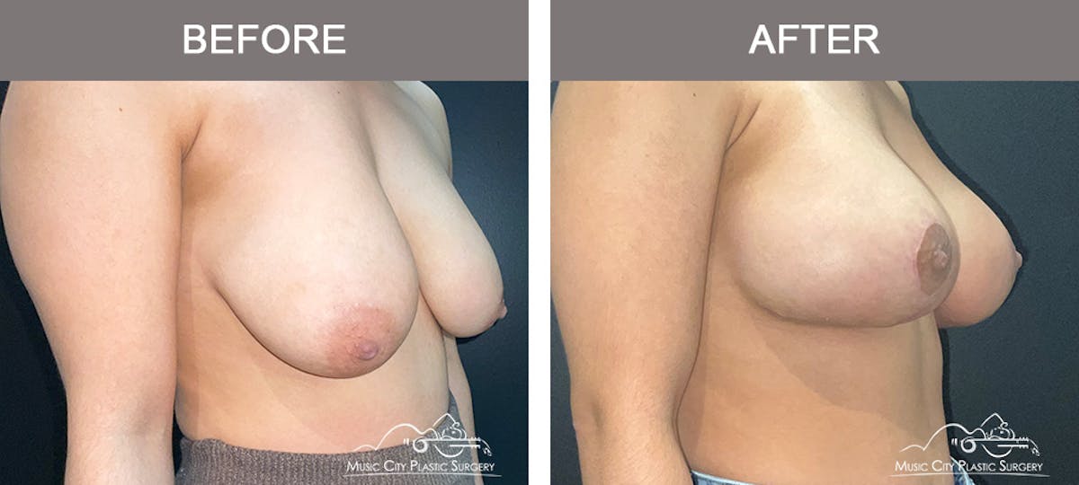 Breast Lift Before & After Gallery - Patient 196294447 - Image 4