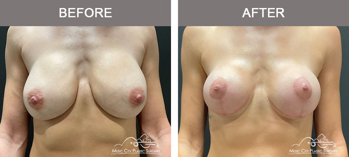 Breast Lift Before & After Gallery - Patient 196294448 - Image 1