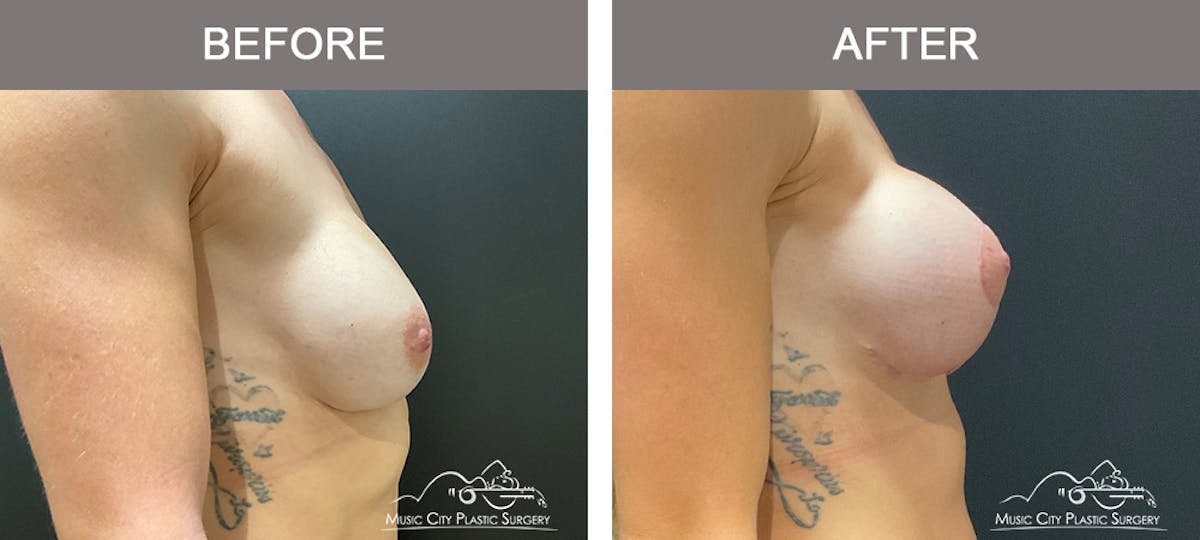 Breast Lift Before & After Gallery - Patient 196294448 - Image 3