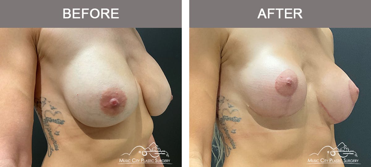 Breast Lift Before & After Gallery - Patient 196294448 - Image 2
