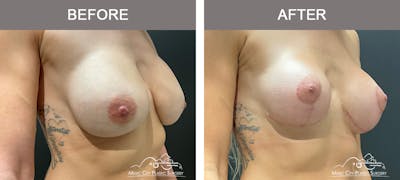 Breast Lift Before & After Gallery - Patient 196294448 - Image 2