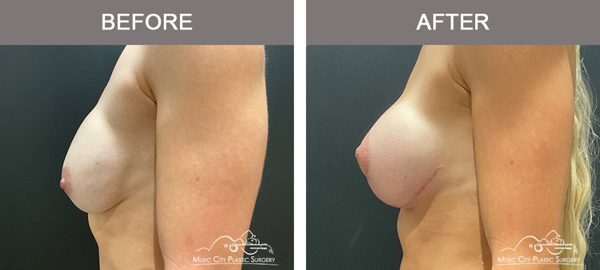Breast Lift Before & After Gallery - Patient 196294448 - Image 5
