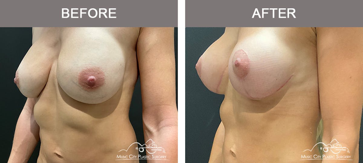 Breast Lift Before & After Gallery - Patient 196294448 - Image 4
