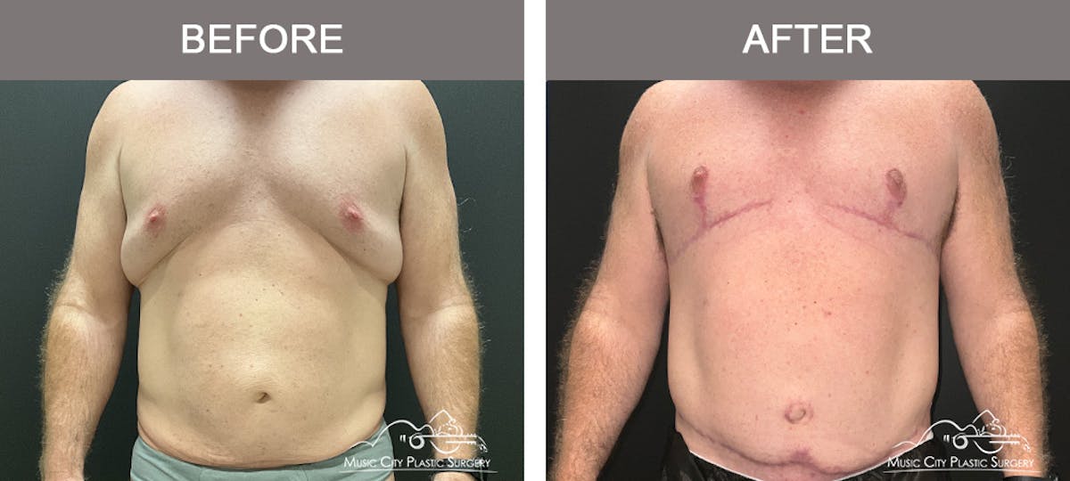 BodyLift Before & After Gallery - Patient 140343 - Image 1