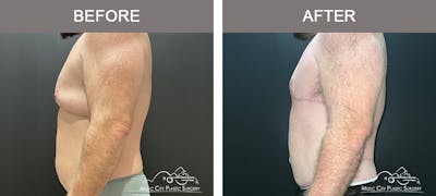 BodyLift Before & After Gallery - Patient 140343 - Image 2