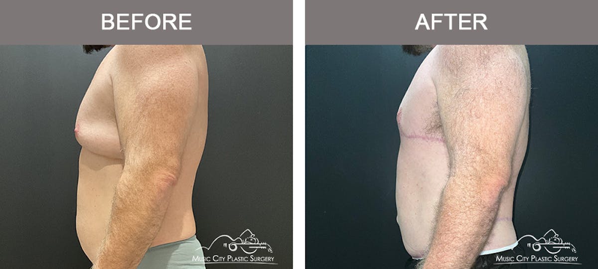 BodyLift Before & After Gallery - Patient 140343 - Image 2