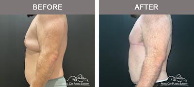 BodyLift Before & After Gallery - Patient 140343 - Image 2