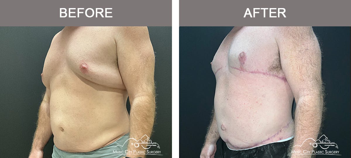 BodyLift Before & After Gallery - Patient 140343 - Image 3