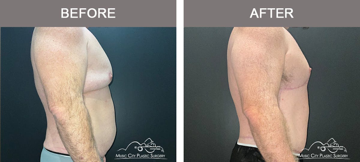 BodyLift Before & After Gallery - Patient 140343 - Image 4