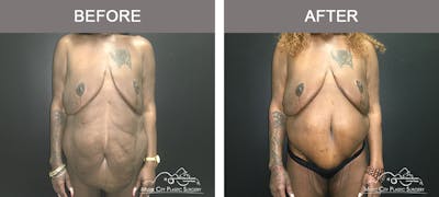 Body Lift Before & After Gallery - Patient 490674 - Image 1