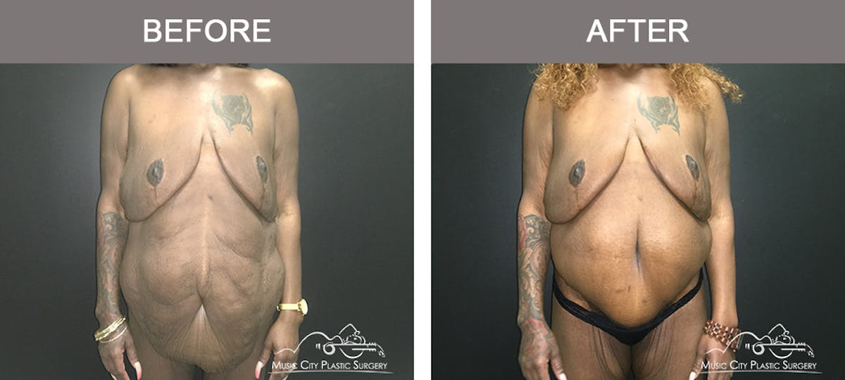 Body Lift Before & After Gallery - Patient 490674 - Image 1