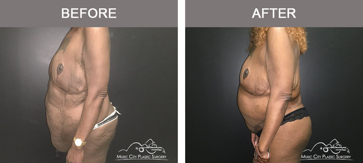 Body Lift Before & After Gallery - Patient 490674 - Image 3