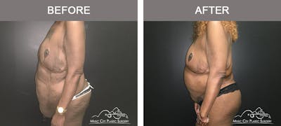 Body Lift Before & After Gallery - Patient 490674 - Image 3