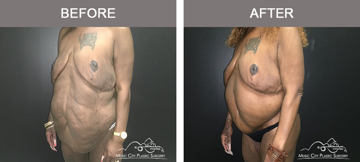 Body Lift Before & After Gallery - Patient 490674 - Image 2