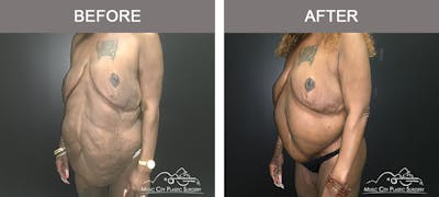 Body Lift Before & After Gallery - Patient 490674 - Image 2