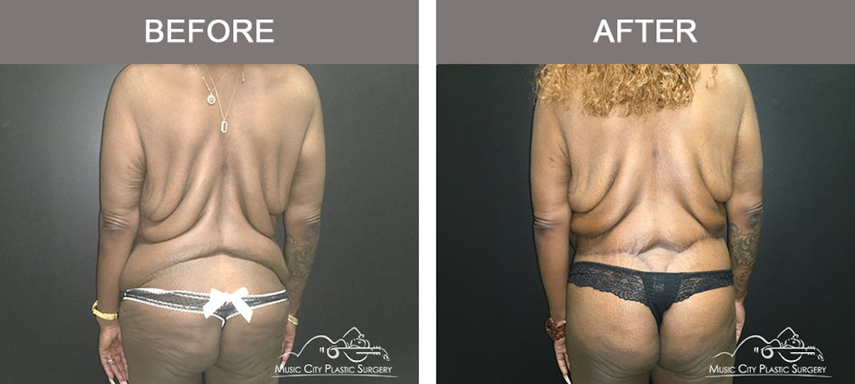 Body Lift Before & After Gallery - Patient 490674 - Image 5