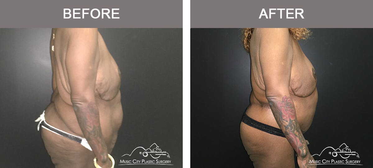 Body Lift Before & After Gallery - Patient 490674 - Image 4