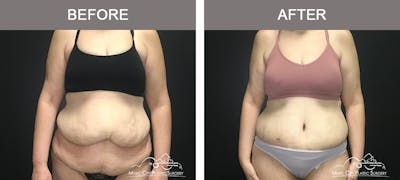 Body Lift Before & After Gallery - Patient 392922 - Image 1