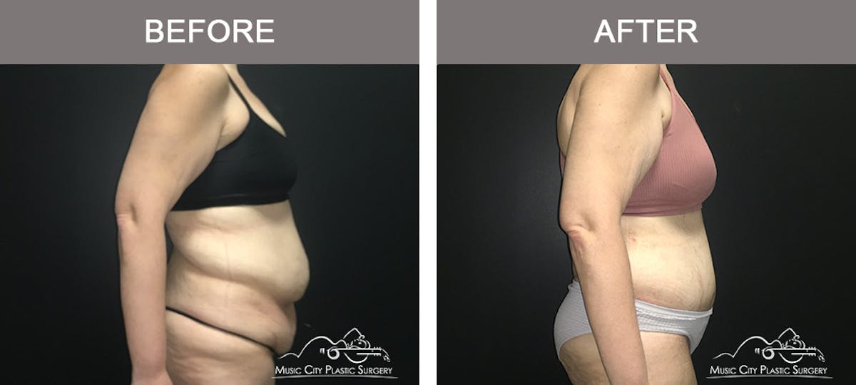 Body Lift Before & After Gallery - Patient 392922 - Image 3