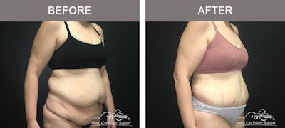 Body Lift Before & After Gallery - Patient 392922 - Image 2