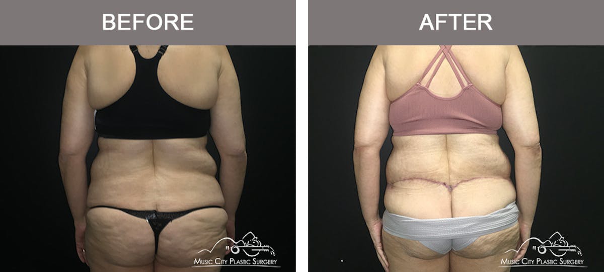 Body Lift Before & After Gallery - Patient 392922 - Image 6