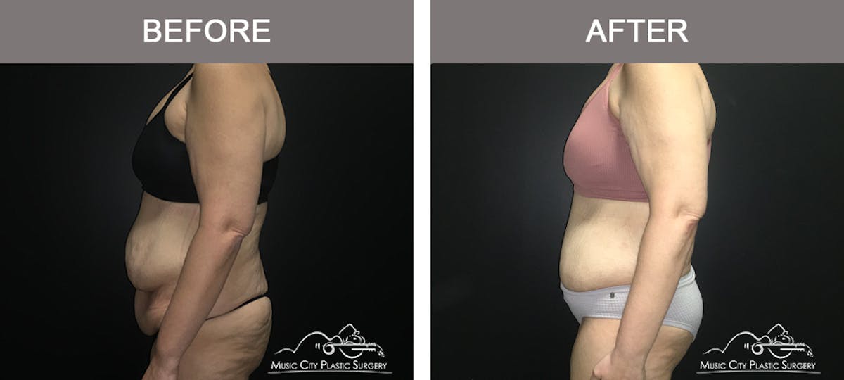Body Lift Before & After Gallery - Patient 392922 - Image 5