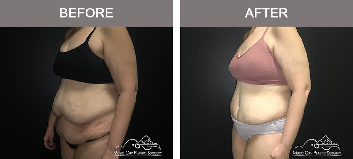 Body Lift Before & After Gallery - Patient 392922 - Image 4