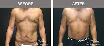 BodyLift Before & After Gallery - Patient 297068 - Image 1