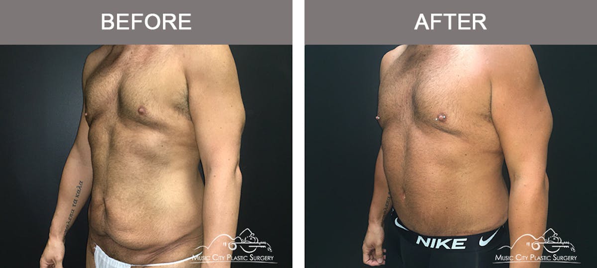 BodyLift Before & After Gallery - Patient 297068 - Image 2