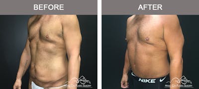 BodyLift Before & After Gallery - Patient 297068 - Image 2