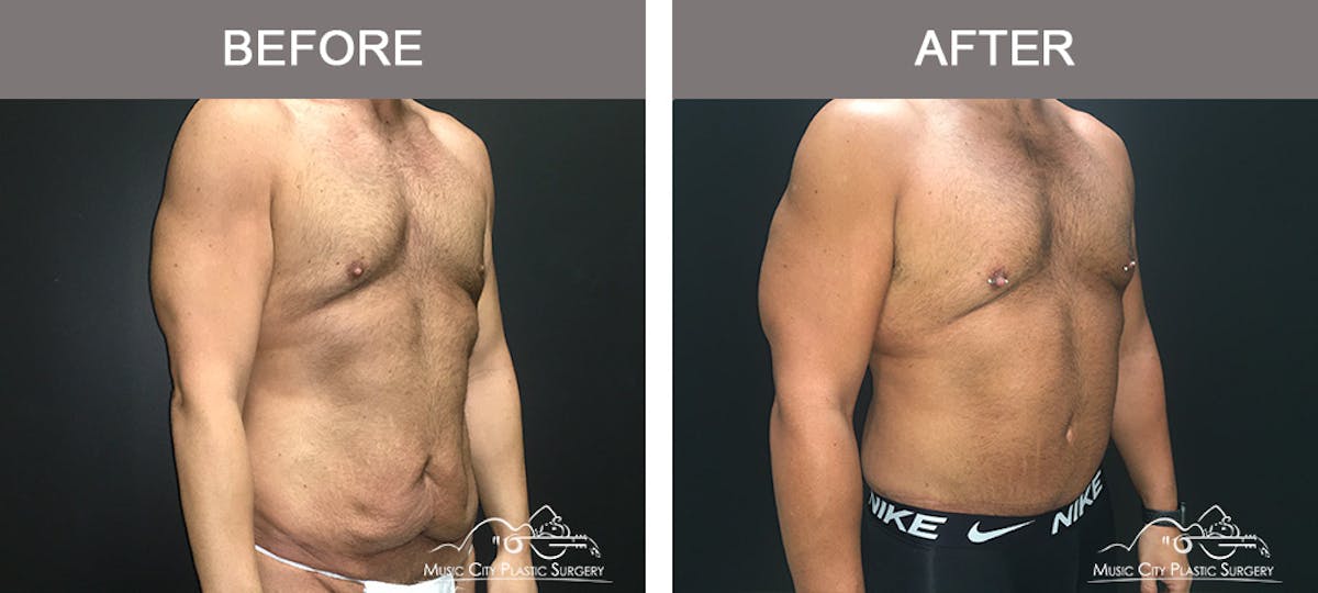 BodyLift Before & After Gallery - Patient 297068 - Image 3