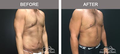 BodyLift Before & After Gallery - Patient 297068 - Image 3