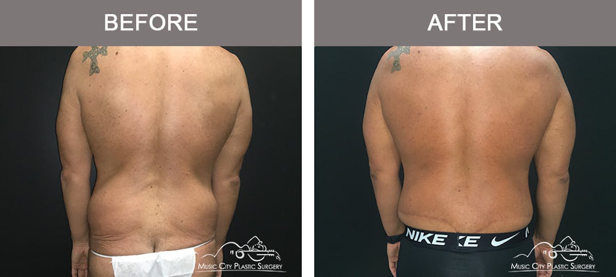 BodyLift Before & After Gallery - Patient 297068 - Image 5