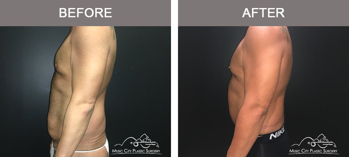 BodyLift Before & After Gallery - Patient 297068 - Image 4