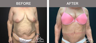 Body Lift Before & After Gallery - Patient 275064 - Image 1